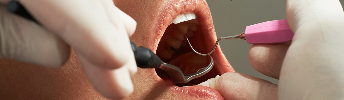 Restore Strength, Beauty & Confidence to Your Smile With Dental Crowns – FC Restore Strength, Beauty & Confidence to Your Smile With Dental Crowns – FC